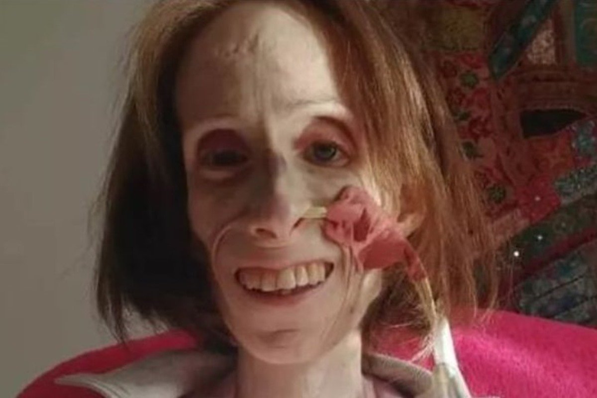 Pesando 20kg, mulher está morrendo de fome devido a doença rara