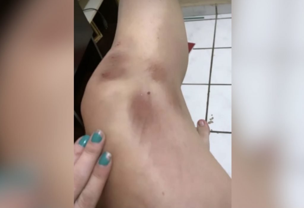 Jovem mostra as marcas das agressões sofridas pelo ex-companheiro