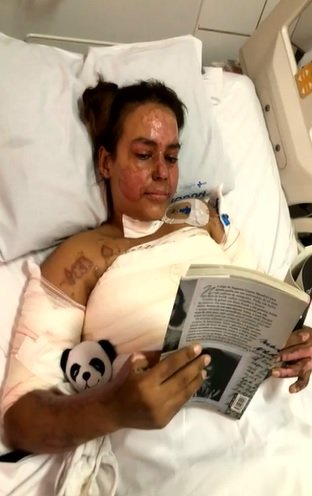 Após sofrer queimadura em escola, Annelise Lopes de Andrade fez cirurgia de enxerto de pele, em Goiânioa, Goiás