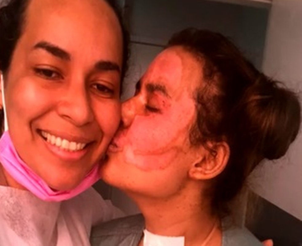 Diolange e a filha, Annelise Lopesa de Andrade, que recebeu enxerto de pele, em Goiânia, Goiás