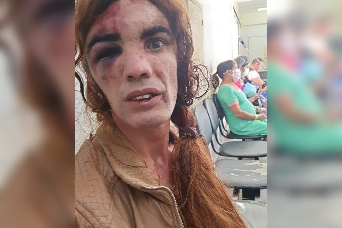 Mulher trans é espancada por homem no DF e mostra rosto desfigurado - Metrópoles
