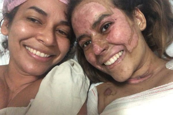 Mãe e filha, estudante que queimou 60% do corpo durante experimento químico na escola em Anápolis, Goiás
