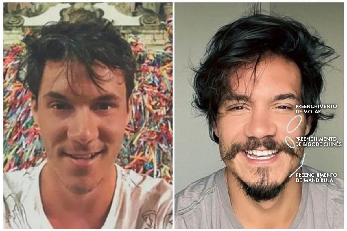 Preenchimento Mandibular Masculino com Antes e Depois