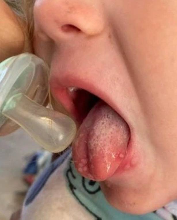 Bebê, 2 anos, herpes labial