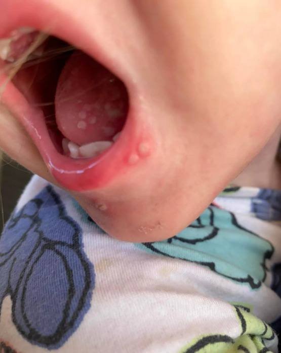 Bebê, 2 anos, herpes labial