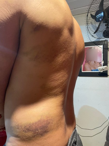 escoriações nas costas