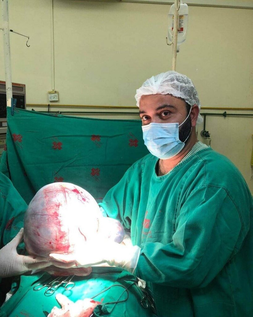 O ginecologista e obstetra Marino Oliveira afirmou que esse é o maior cisto de ovário que ele já viu