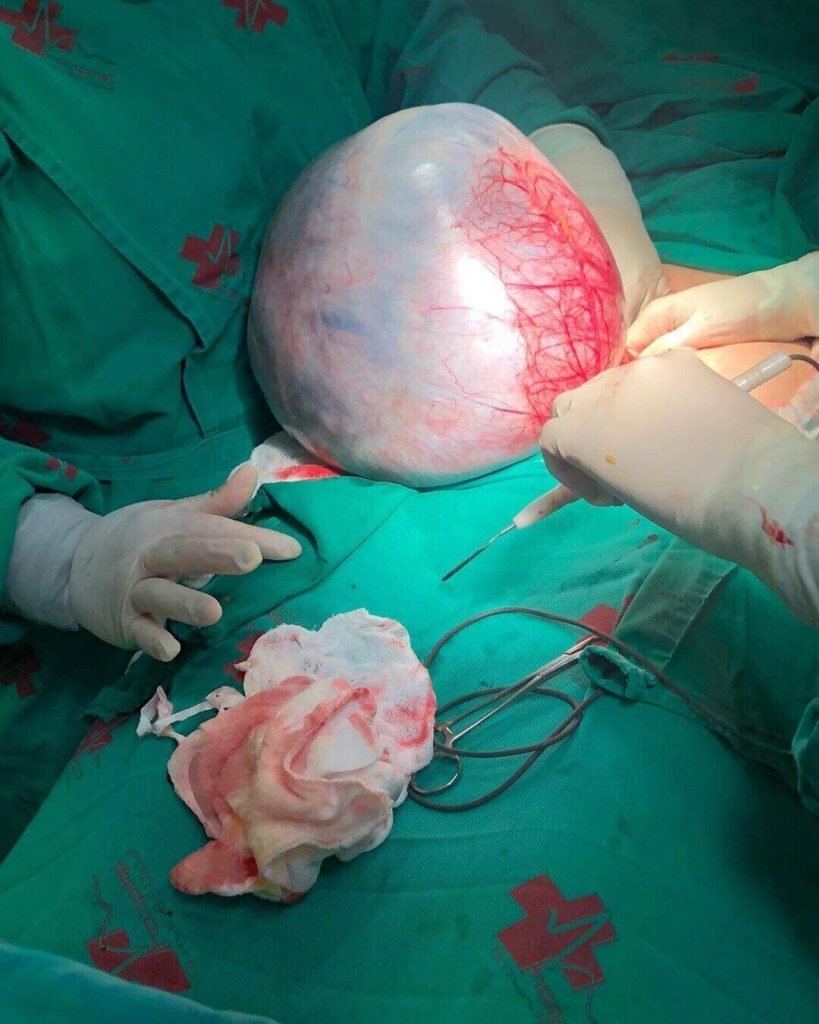 O medico relatou que, apesar de magra, a idosa estava com uma barriga parecida com a de uma gestante no final da gestação