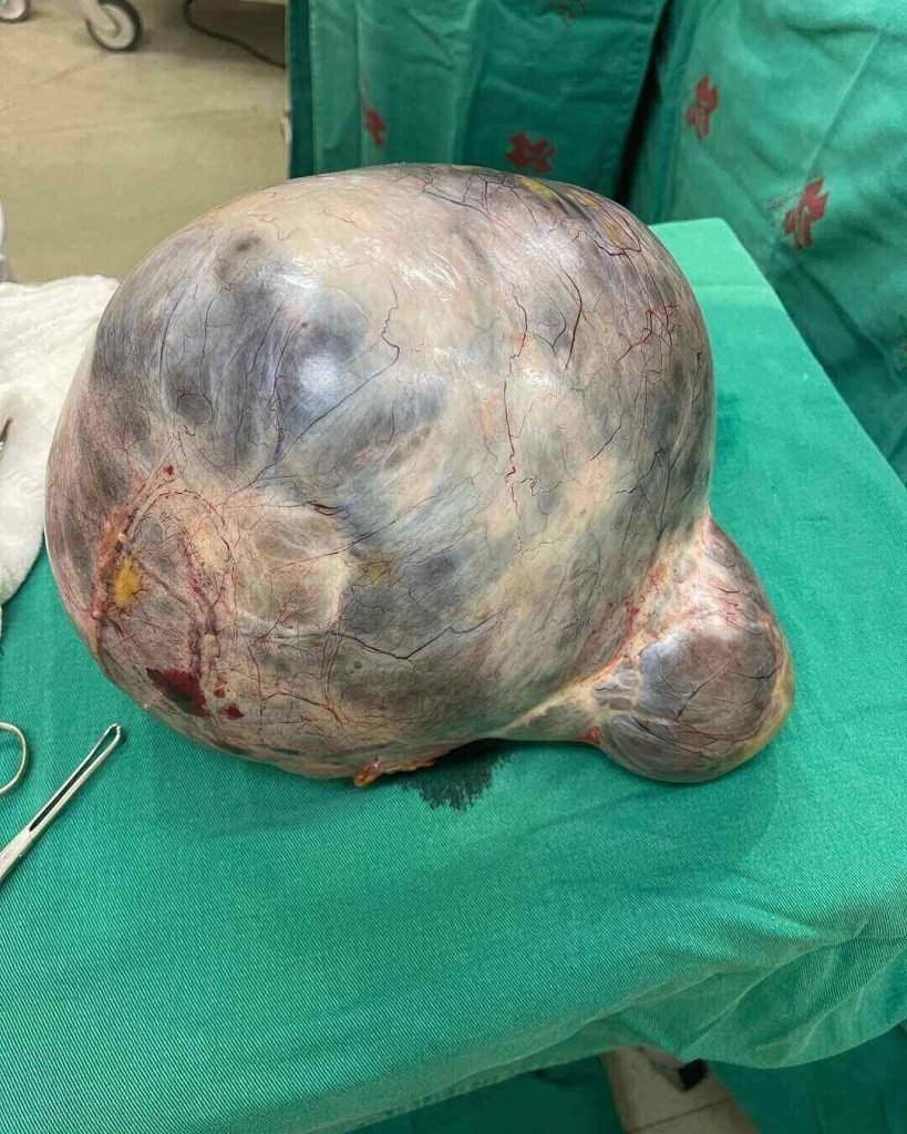O ginecologista e obstetra Marino Oliveira afirmou que esse é o maior cisto de ovário que ele já viu