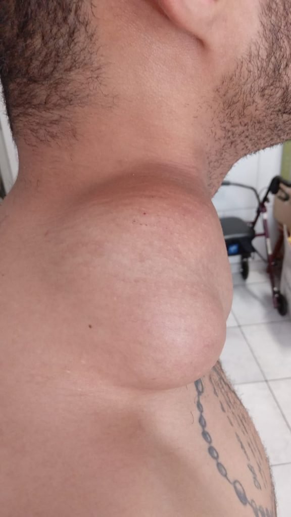 Homem espera cirurgia para retirar tumor