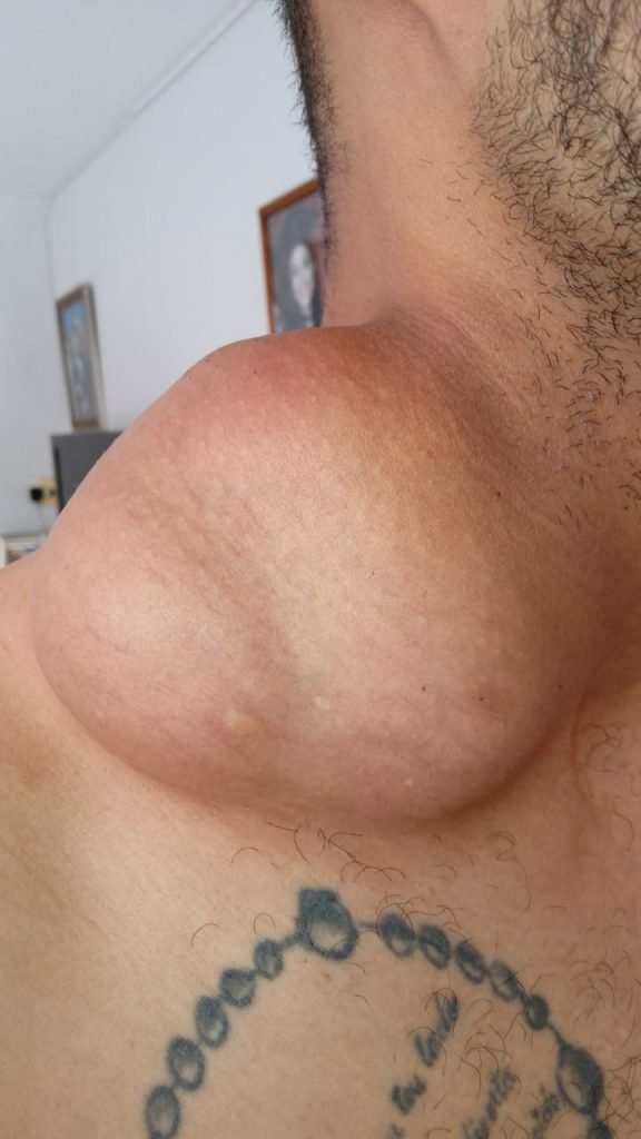Homem espera cirurgia para retirar tumor