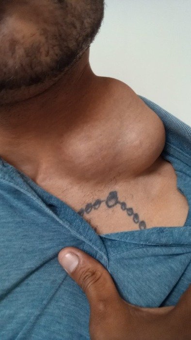 Homem espera cirurgia para retirar tumor