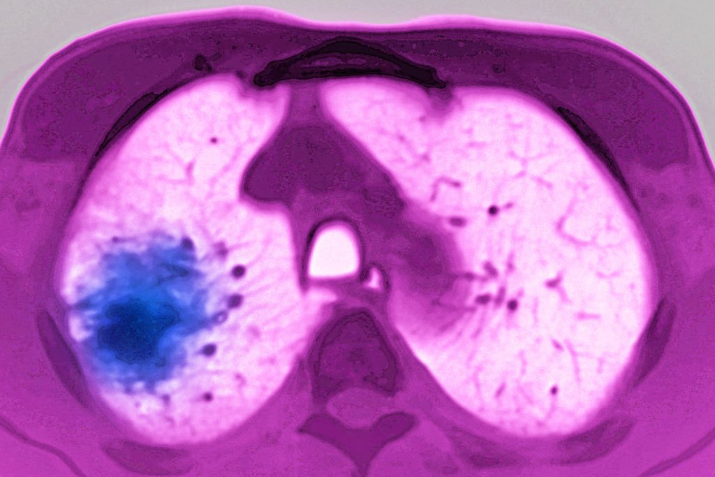 Imagem de um raio-x de pulmões com câncer - Metrópoles