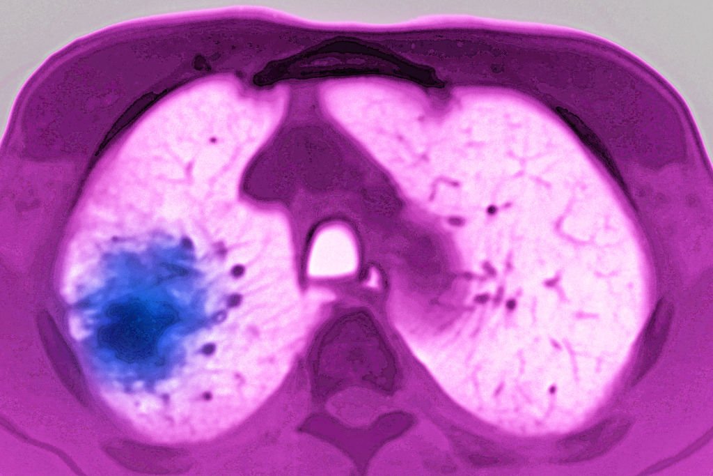 Image of an x-ray of cancerous lungs - Metropolis