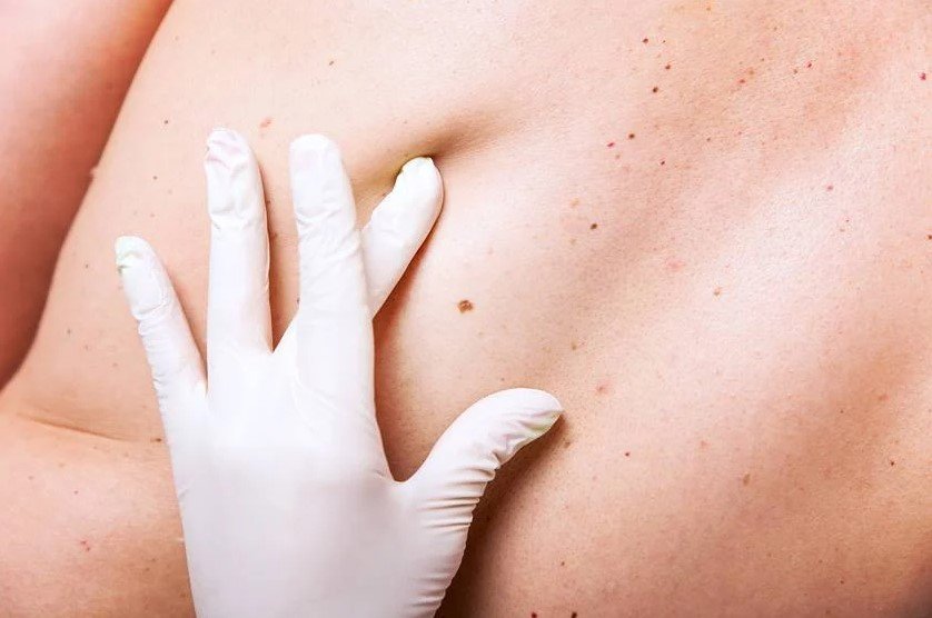 Pessoa sendo examinada com suspeita de câncer de pele - Metrópoles