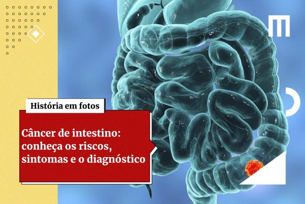 The illustration shows a tumor in the human intestine - Metropolis