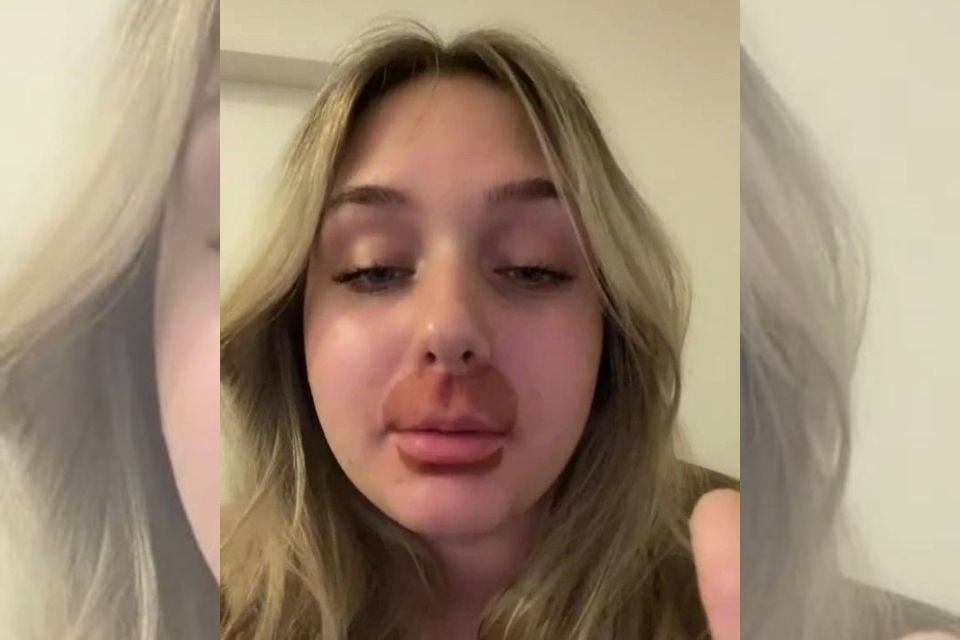 mulher com buço queimado