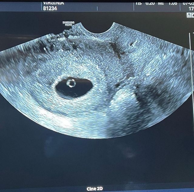 A foto mostra um ultrassom de um bebê ainda nas suas primeiras semanas dentro da barriga da mãe, Virgínia Fonseca
