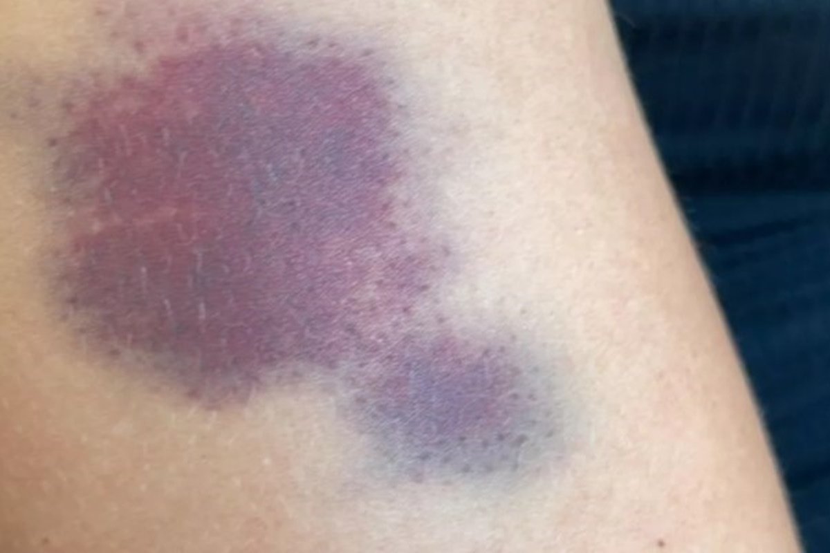 Mulher ficou com hematoma em braço após ser agredida por companheiro em Paraúna, Goiás