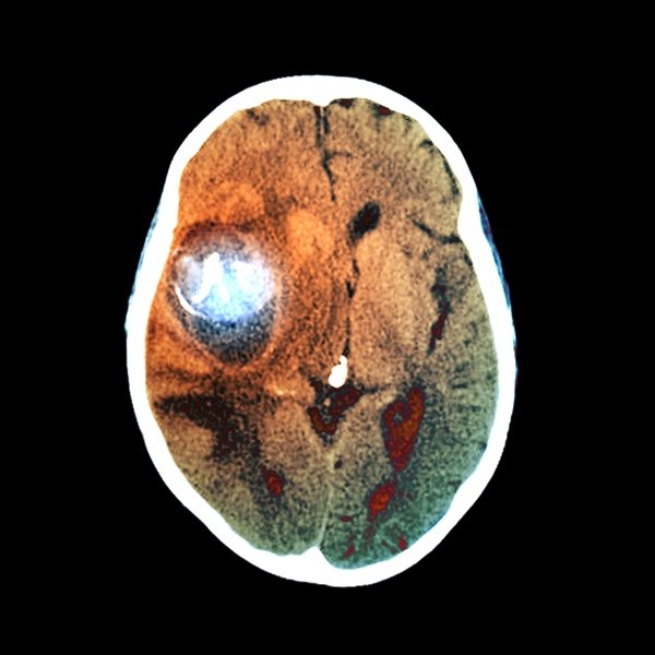 Ilustração de um aneurisma cerebral - Metrópoles