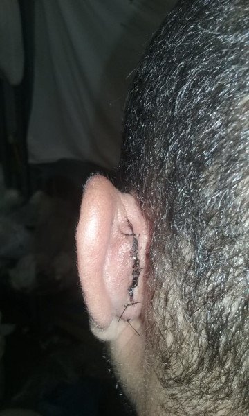 orelha com parte de trás costurada