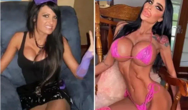 mulher em foto com antes e depois, após ela fazer mais de 20 procedimentos estéticos