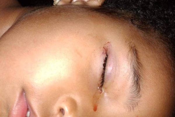 Menina de 3 anos é atacada por rato enquanto dormia. Mordida de rato e lágrima com sangue