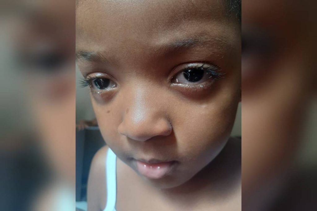 Lorena Fialho, de apenas 5 anos, do Rio de Janeiro, teve problema nos olhos após contato com pomada modeladora para cabelo