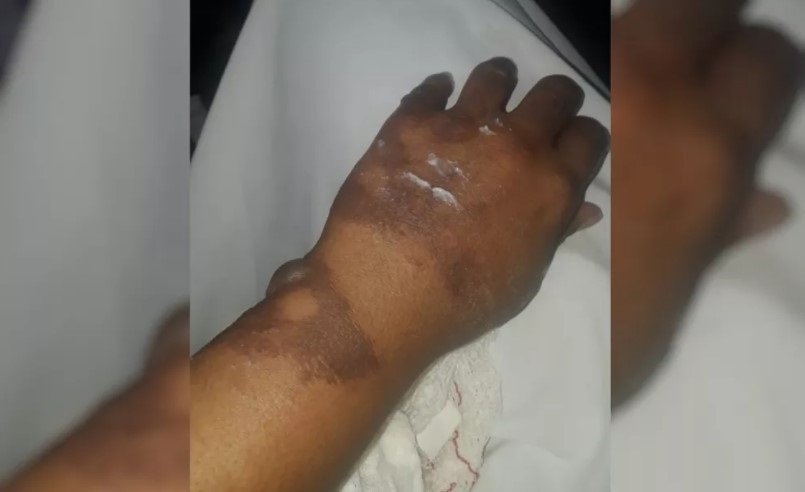 Mão queimada da mulher que teve fogo ateado a ela