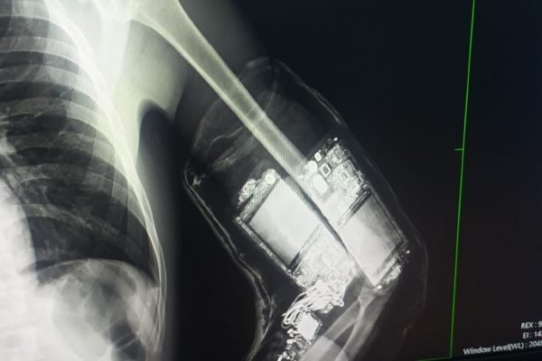 foto em raio-x de um braço engessado