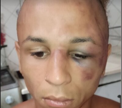 A mulher trans foi agredida com socos e pisões no rosto