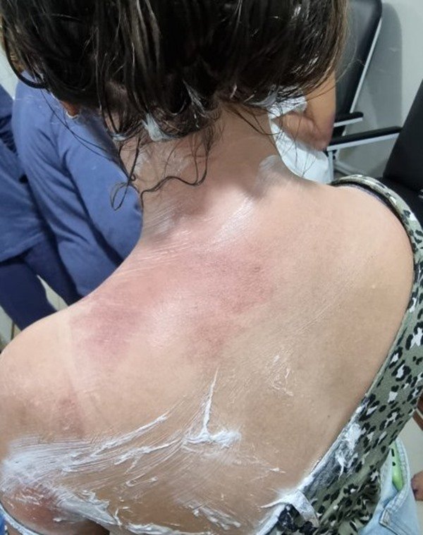 pessoa com a pele queimada coberta com pomada