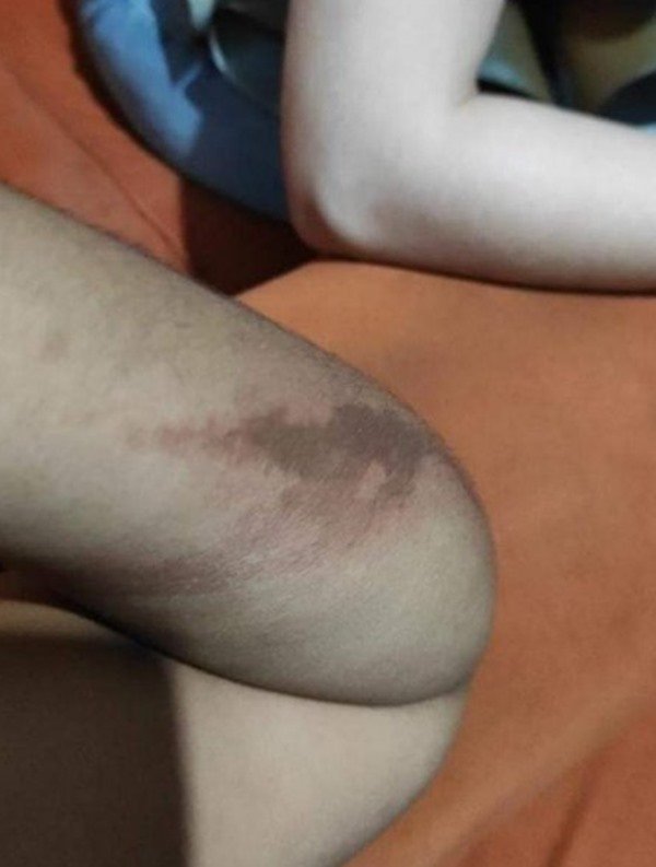 pessoa com a pele do braço queimada e com manchas vermelhas