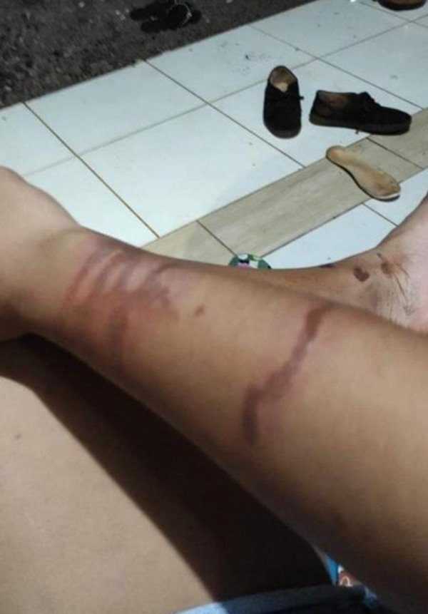 pessoa com a pele do braço queimada e com manchas vermelhas