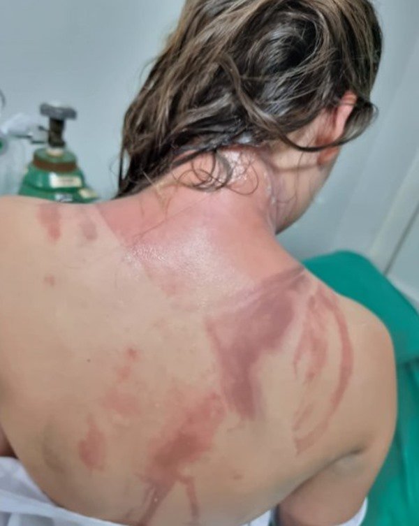 pessoa com a pele das costas queimada coberta com pomada