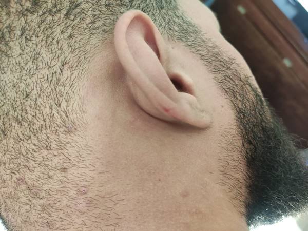Foto mostra hematoma