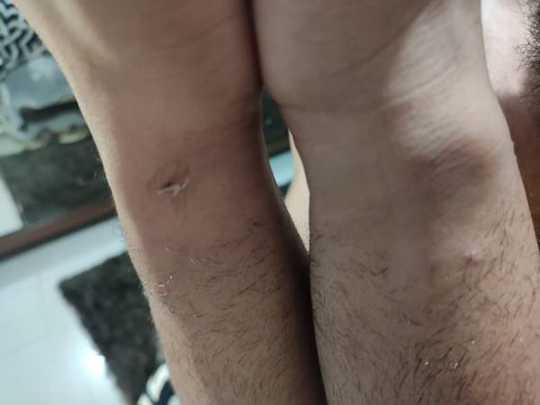 Foto mostra hematoma