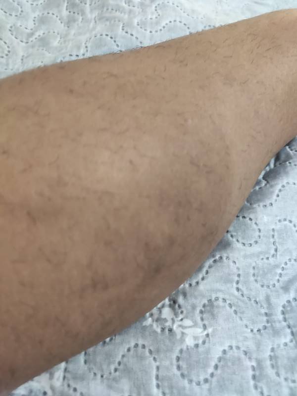 Foto mostra hematoma