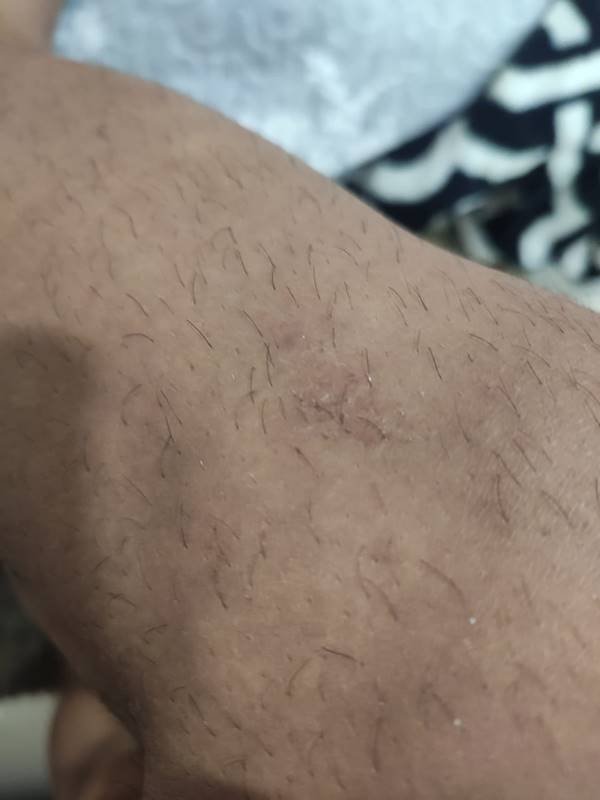 Foto mostra hematoma