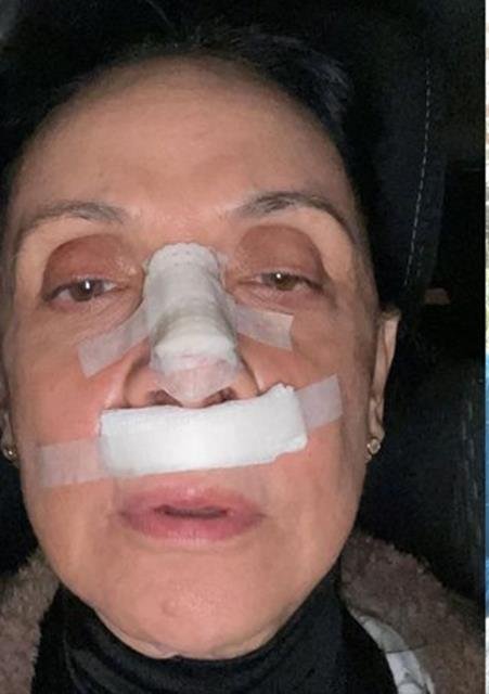 Cininha de Paula mostra rosto machucado