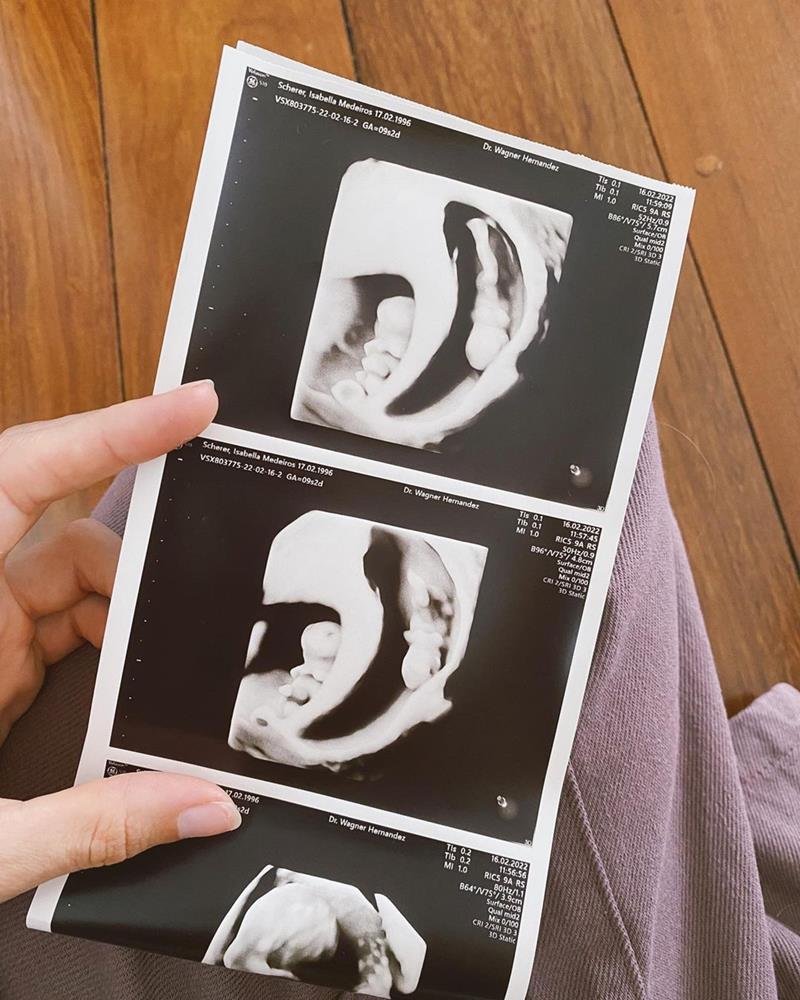Ultrassom de campeã do Masterchef, Isabella Scher, mostra que ela está grávida de gêmeos - Metrópoles