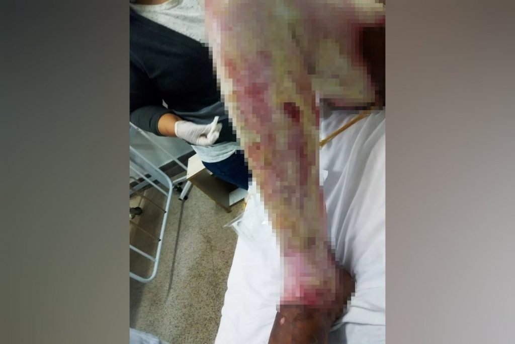 Depois de semanas internada, ela morreu devido aos ferimentos