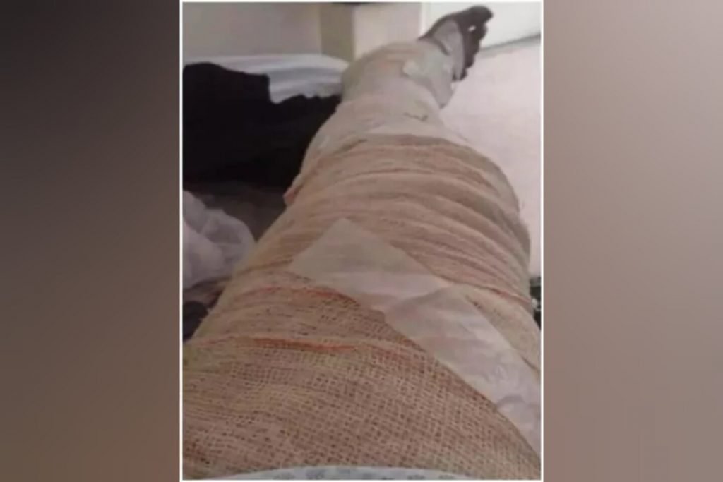 A mulher de 26 anos queimou 85% do corpo ao sofrer acidente tentando usar álcool combustível para cozinhar