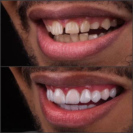 Ex-BBB Vyni faz mudança radical nos dentes