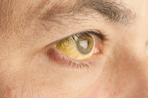 Pessoa com os olhos amarelados - Metrópoles