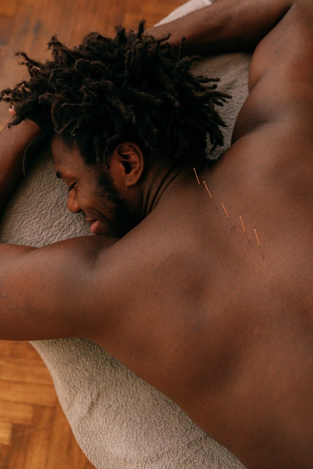 Homem deitado com agulhas de acupuntura nas costas