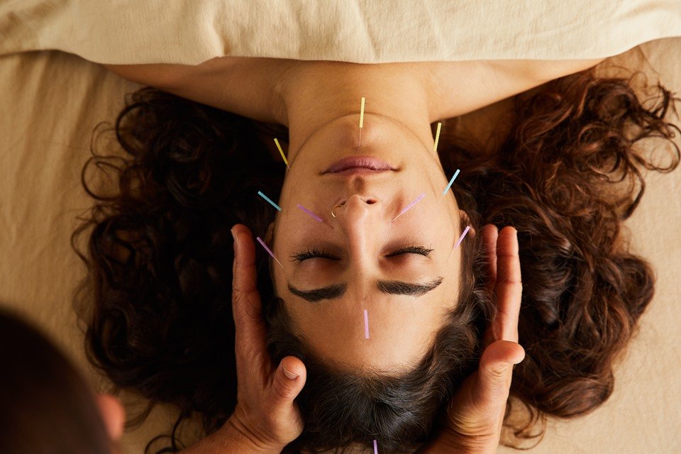 Rosto de mulher com agulhas de acupuntura aplicadas
