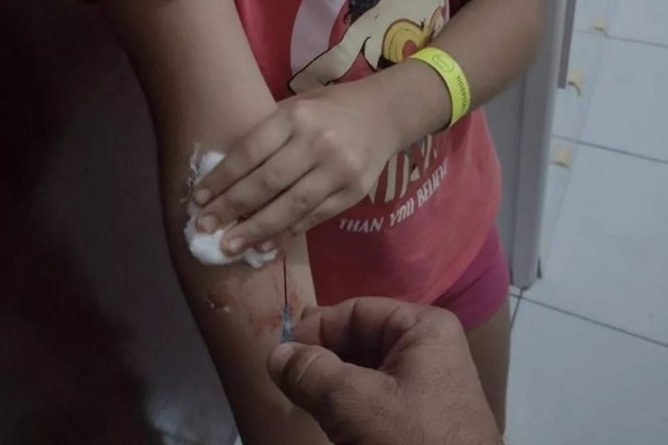 Criança sai de hospital com agulha “esquecida” no braço, na