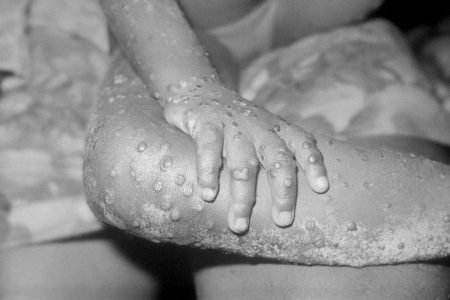 Monkeypox Virus, varíola de macacos