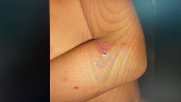 Fotografia colorida de hematoma no braço